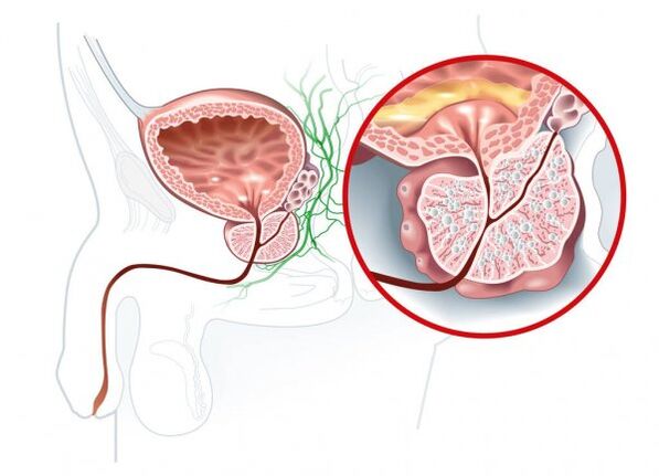 Síntomas de prostatitis