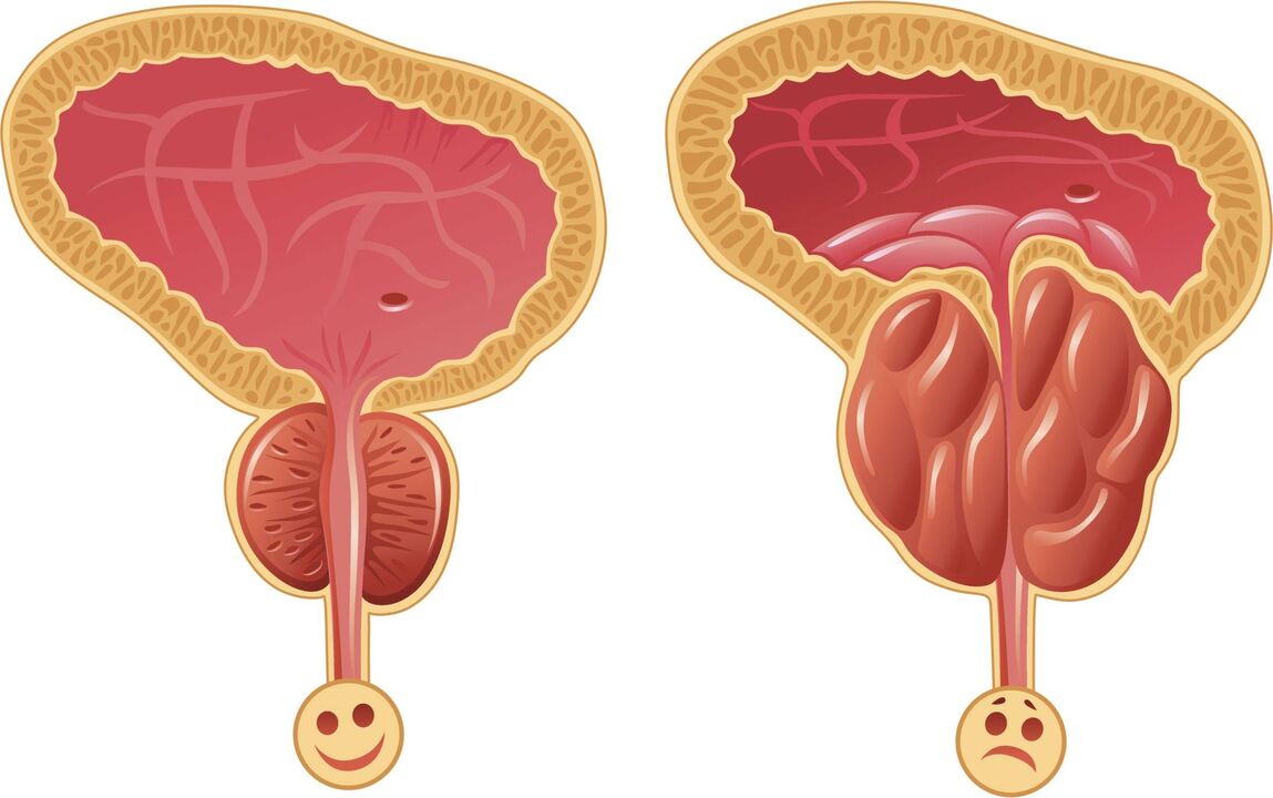 razones para el desarrollo de la prostatitis