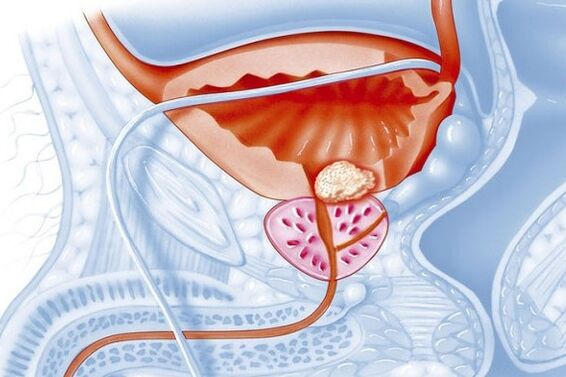 Proceso inflamatorio en la próstata