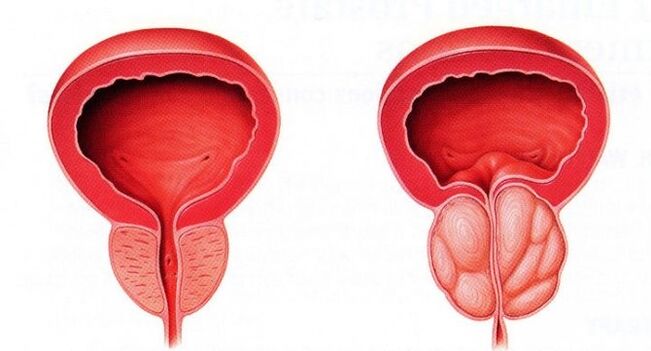 Próstata sana e inflamada con prostatitis crónica.