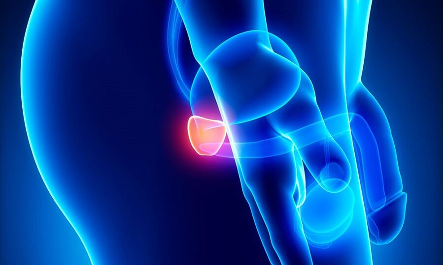 Inflamación de la próstata con prostatitis