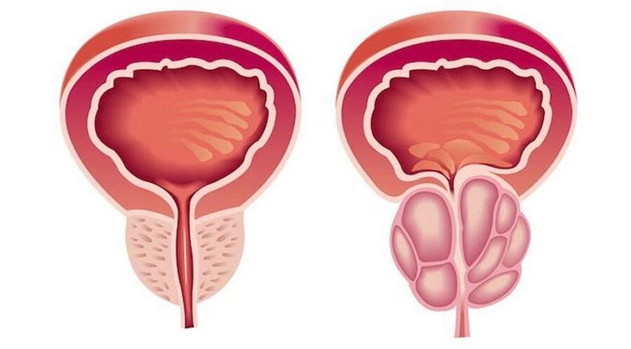 Prostata sana e inflamada con prostatitis