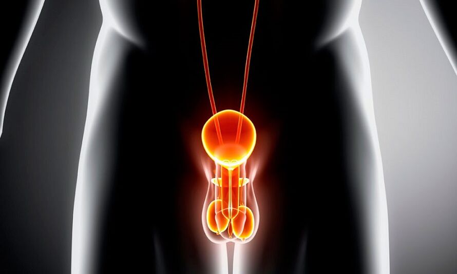 Sistema genitourinario inflamado para prostatitis