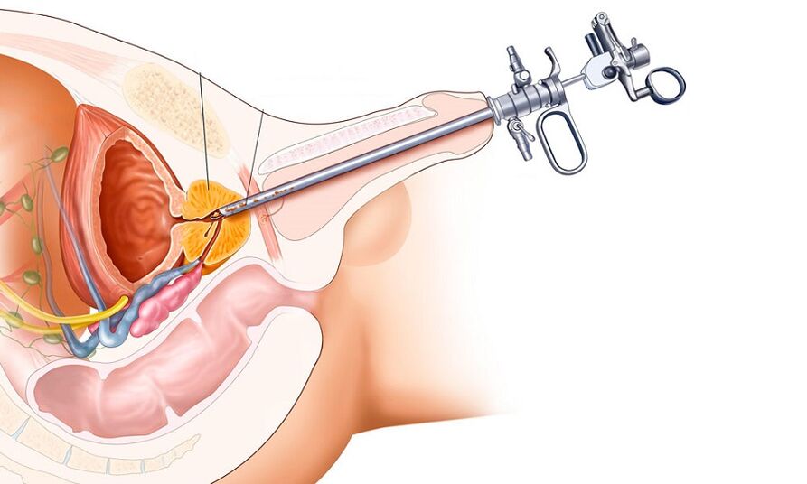Tratamiento quirúrgico de la prostatitis