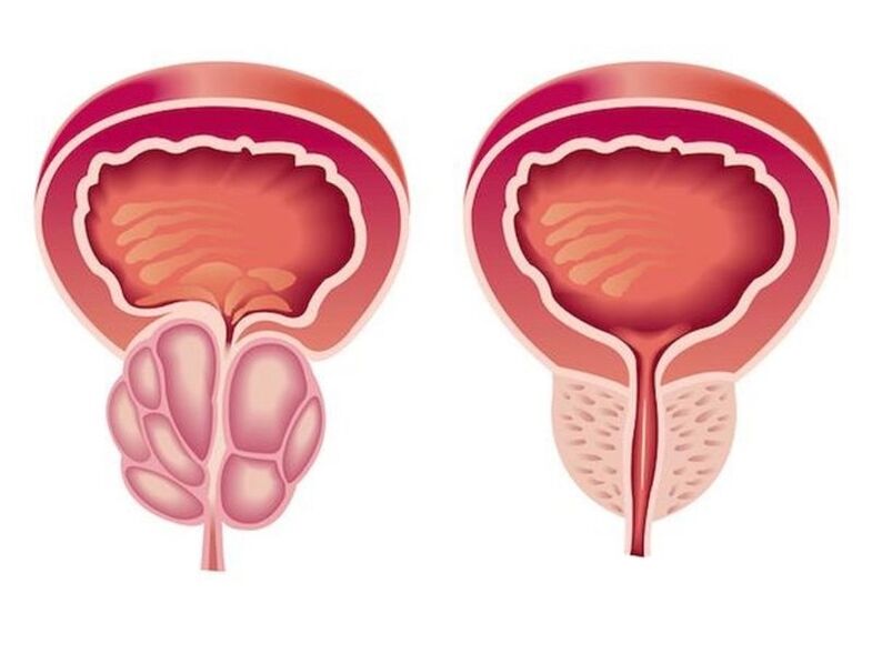Cómo se ve la prostatitis